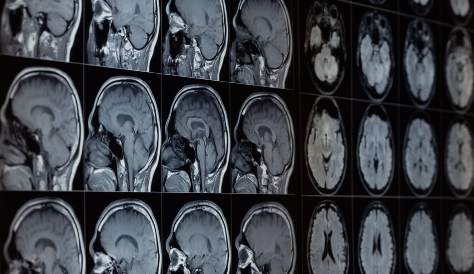 Alzheimer's Disease