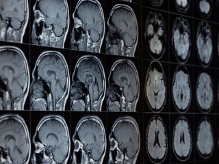 thumbnail - Alzheimer's Disease
